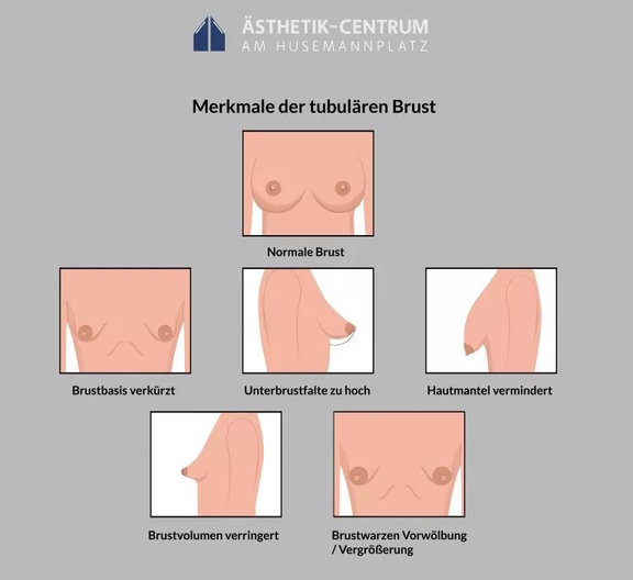 Grafik Merkmale Tubuläre Brust, Plastische und Ästhetische Chirurgie in Bochum, Ästhetik-Centrum
